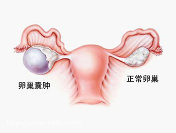 卵巢囊肿?老艾堂古方理疗关爱女性健康!