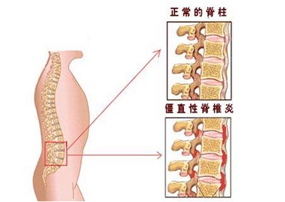 脊柱“杀手”强直性脊柱炎，看龙虎灸如何让你能屈能伸