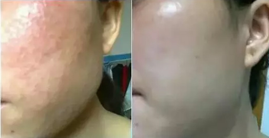 面部艾灸前和艾灸后的真实对比!