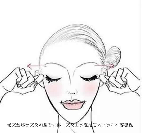 老艾堂邢台艾灸加盟告诉你：艾灸出水泡是怎么回事？不容忽视